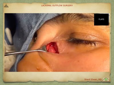 Lacrimal Outflow Surgery.063.jpeg
