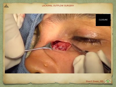 Lacrimal Outflow Surgery.064.jpeg