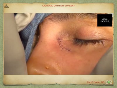 Lacrimal Outflow Surgery.065.jpeg