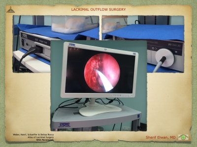 Lacrimal Outflow Surgery.067.jpeg