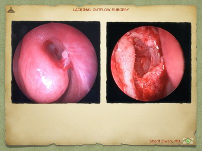 Lacrimal Outflow Surgery.070.jpeg