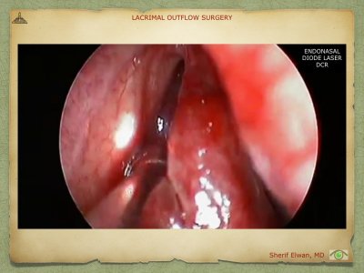 Lacrimal Outflow Surgery.080.jpeg