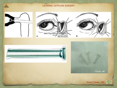 Lacrimal Outflow Surgery.082.jpeg
