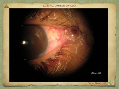 Lacrimal Outflow Surgery.083.jpeg