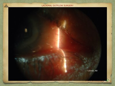 Lacrimal Outflow Surgery.085.jpeg