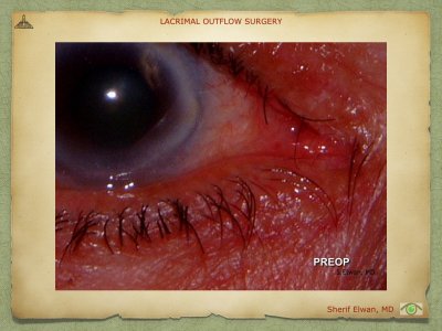 Lacrimal Outflow Surgery.087.jpeg