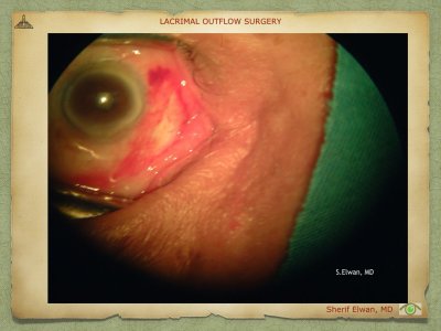 Lacrimal Outflow Surgery.088.jpeg