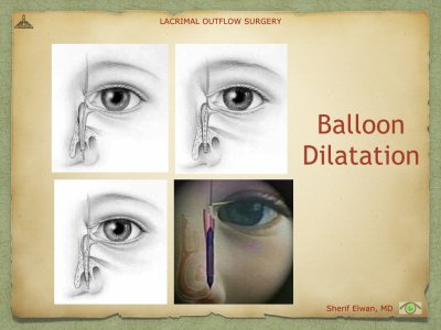 Lacrimal Outflow Surgery.090.jpeg