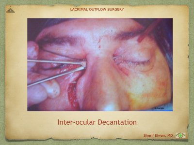Lacrimal Outflow Surgery.096.jpeg