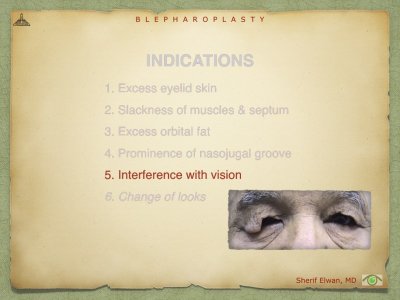 Blepharoplasty.007.jpeg