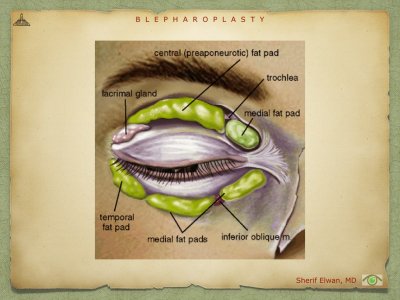 Blepharoplasty.013.jpeg