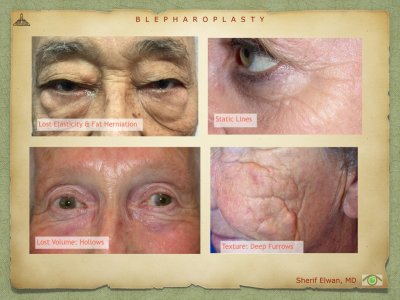 Blepharoplasty.019.jpeg