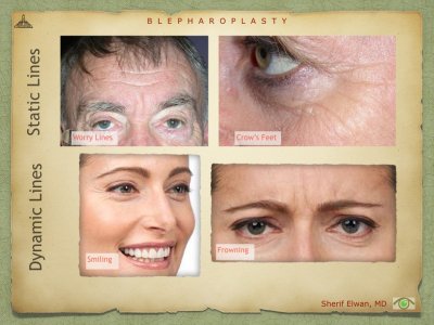 Blepharoplasty.020.jpeg