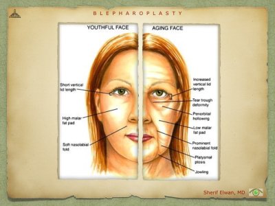 Blepharoplasty.021.jpeg