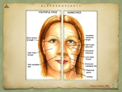 Blepharoplasty.021.jpeg