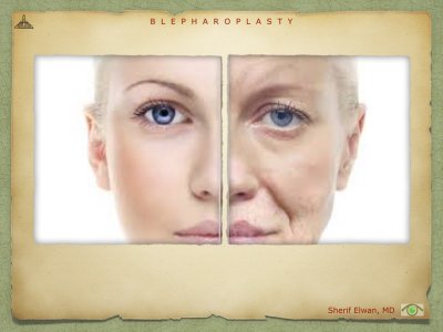 Blepharoplasty.022.jpeg