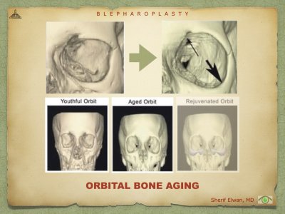 Blepharoplasty.025.jpeg