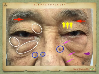 Blepharoplasty.026.jpeg
