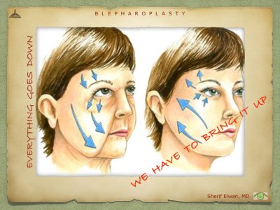 Blepharoplasty.028.jpeg