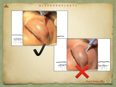 Blepharoplasty.030.jpeg