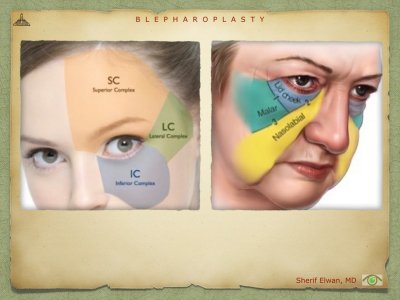 Blepharoplasty.031.jpeg