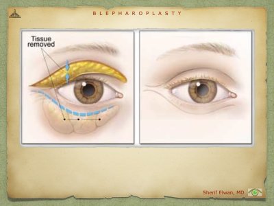 Blepharoplasty.033.jpeg