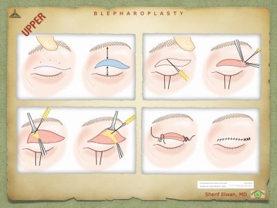 Blepharoplasty.038.jpeg