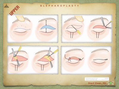 Blepharoplasty.038.jpeg