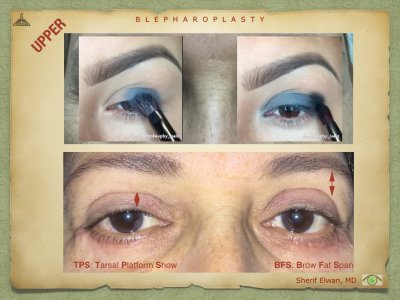 Blepharoplasty.040.jpeg