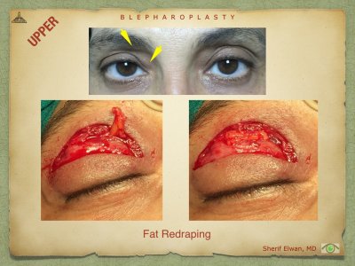 Blepharoplasty.048.jpeg