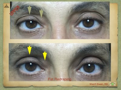 Blepharoplasty.049.jpeg