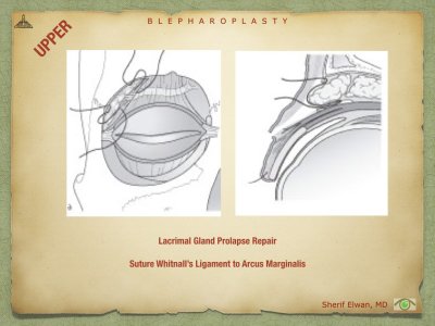 Blepharoplasty.051.jpeg