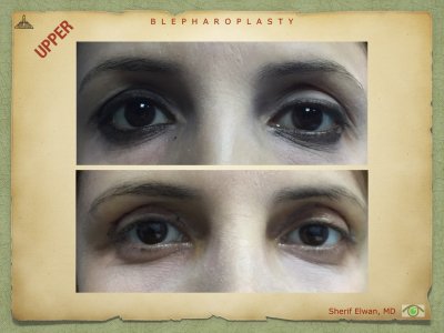 Blepharoplasty.054.jpeg
