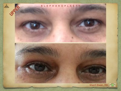 Blepharoplasty.055.jpeg