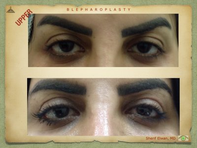 Blepharoplasty.061.jpeg