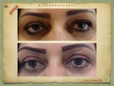 Blepharoplasty.062.jpeg