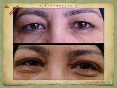 Blepharoplasty.063.jpeg