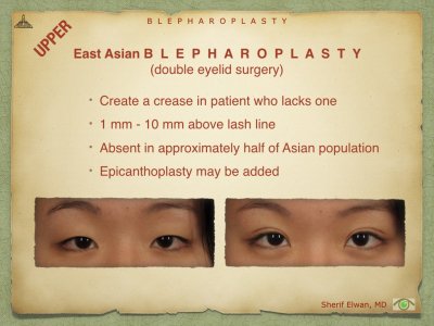 Blepharoplasty.065.jpeg