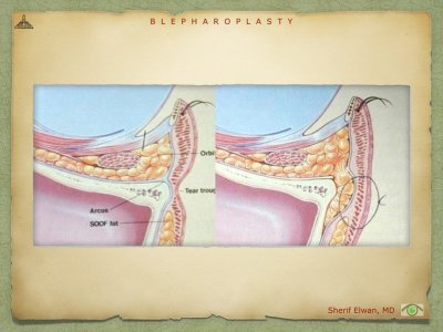 Blepharoplasty.067.jpeg