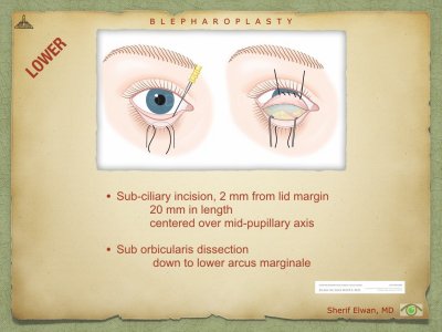 Blepharoplasty.069.jpeg