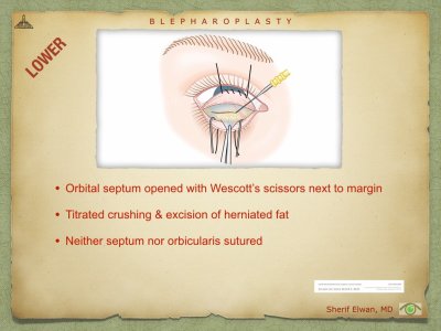 Blepharoplasty.070.jpeg