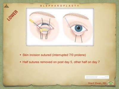 Blepharoplasty.071.jpeg