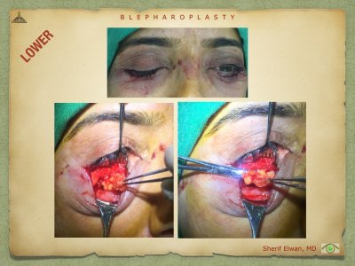 Blepharoplasty.072.jpeg