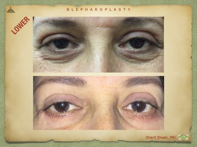 Blepharoplasty.073.jpeg