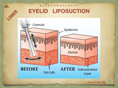 Blepharoplasty.082.jpeg