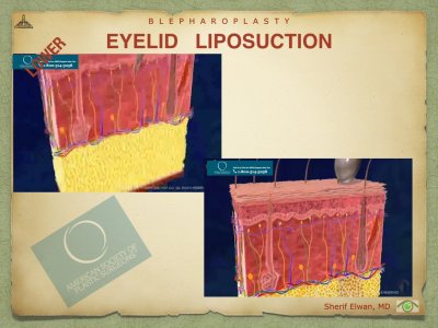 Blepharoplasty.083.jpeg