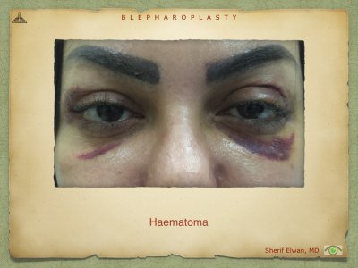 Blepharoplasty.092.jpeg