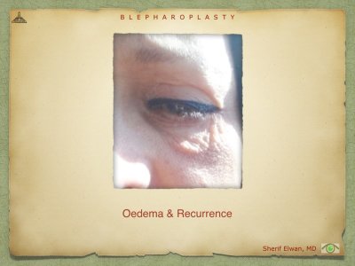 Blepharoplasty.097.jpeg