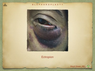 Blepharoplasty.098.jpeg