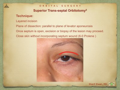 Orbital Surgery.069.jpeg